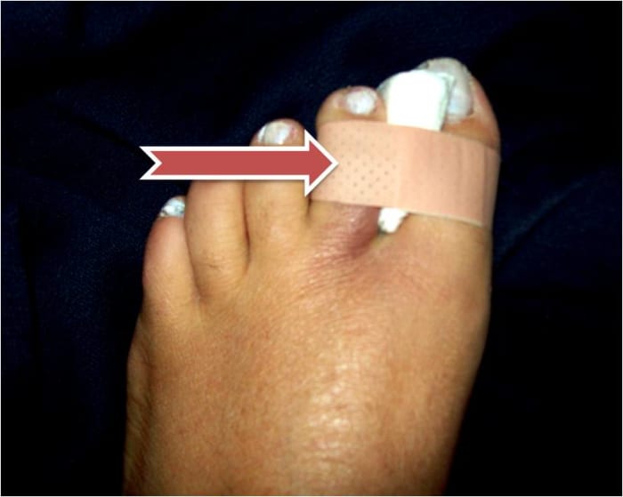 How to Treat an Injured or Broken Toe by BuddyTaping HealthProAdvice