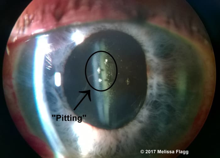 The circle shows the area of pitting on this IOL. Although the pitting is in the visual axis, it does not affect the patient's visual acuity.