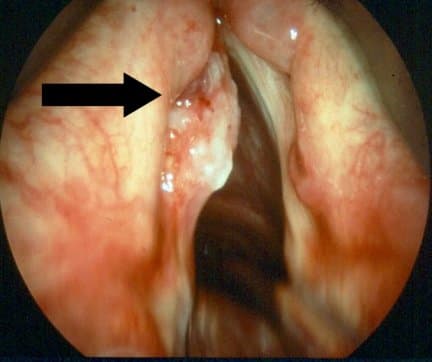 This is a photo of a vocal polyp which can be caused from yeliing, screaming and singing incorrectly.