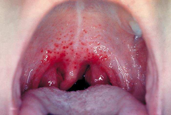Severe sore throat with infection