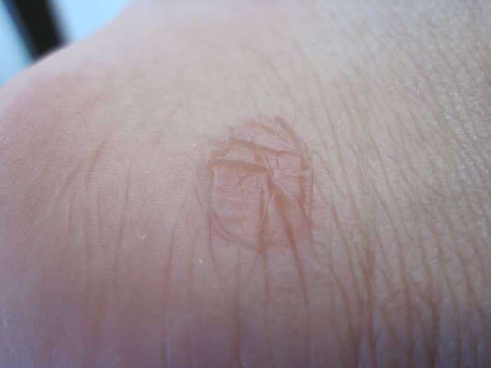 This is the lovely blister on my heel, which I also didn't do anything with. Don't worry, they will heal.