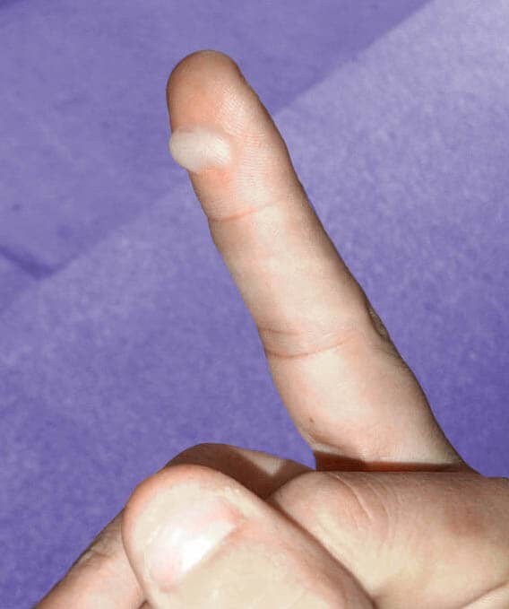 This is one caused by a burn. Even first-degree burns can result in blistering, though it usually won't appear for a couple of days after the trauma occurs.