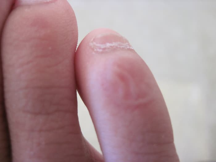 The blister on my right pinky toe two days after I caused it. It looked a lot worse a couple of days ago, tiny balloon bad.I didn't do anything to it; it healed by itself.