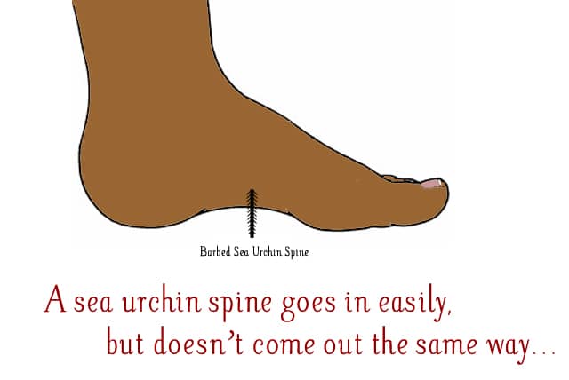 How to Get Sea Urchin Spines Out and Treat Stings - RemedyGrove