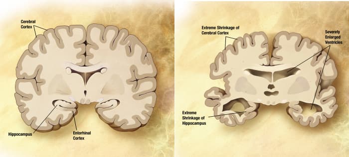 This diagram from the National Institute on Aging shows the brain shrinkage that is a symptom of Alzheimers Disease. Once you know the role of water, it's a short step to suspecting that lack of water might be short circuiting the memory pathways.