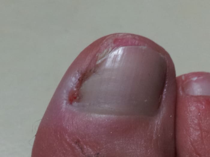 After applying the oil religiously for three months, the infected part of the nail fell off.