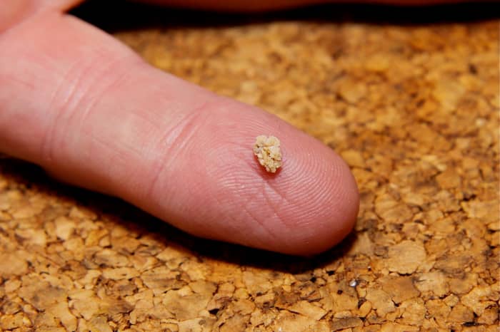 Even a tiny kidney stone can cause extreme pain. Avoid these by changing your diet or with the assistance of natural herbal supplements.