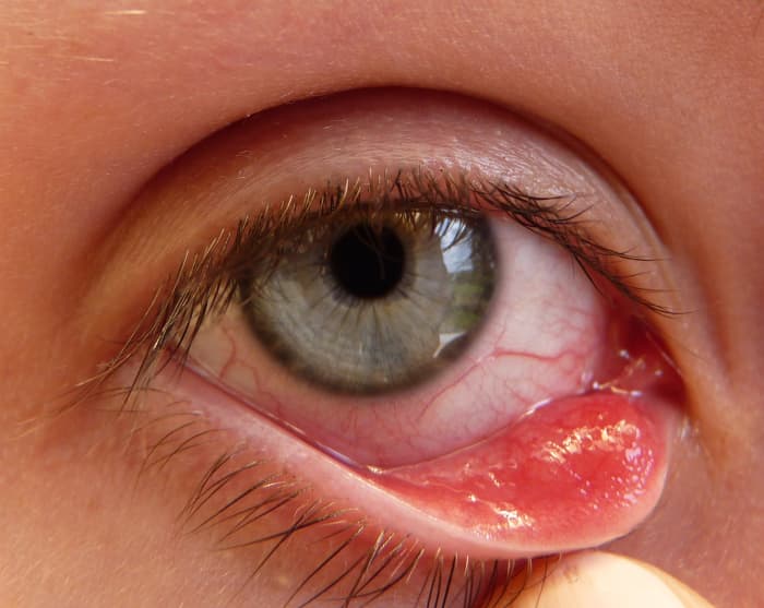 A chalazion is a slow-growing infection of the oil-producing glands in the eyelid. Chalazions look like styes but they are not painful.