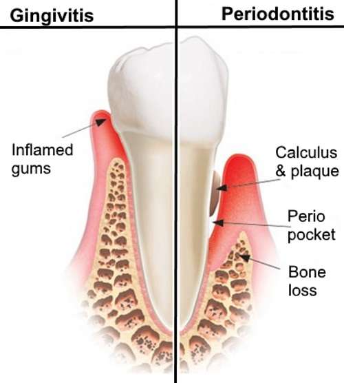 How to Manage Gum Disease Naturally RemedyGrove
