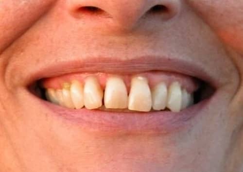 With dedicated effort, periodontal inflammation is decreased, tissues heal, and disease progression is arrested
