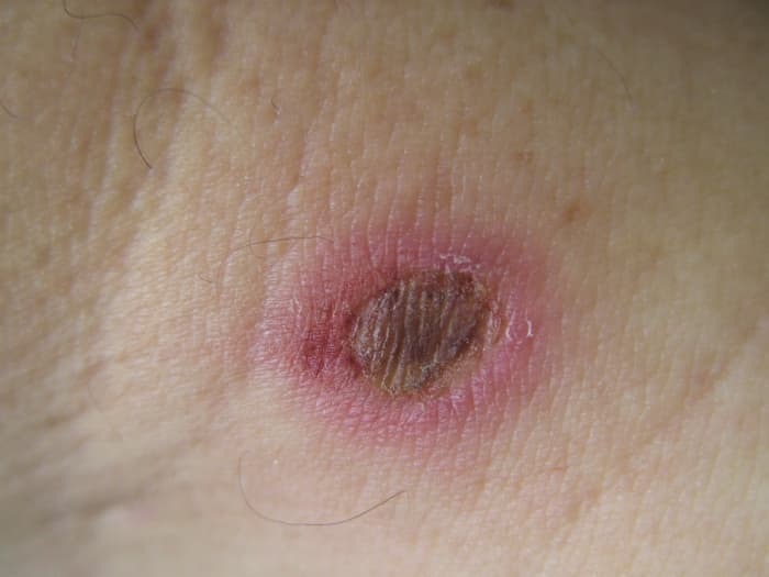 Second degree and third degree burns should be treated medically by a doctor