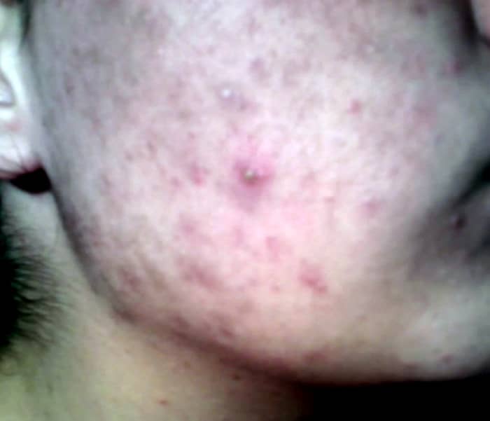 Acne is a common skin condition teenagers. There are many home remedies that you can use to clear up that skin condition.