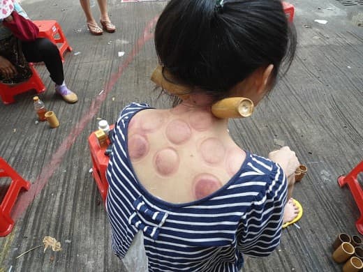"Woman receiving fire cupping at a roadside business in Haikou, Hainan, China" Wikipedia. Cups made of bamboo. -