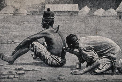 An African medicine man or shaman cupping a patient.