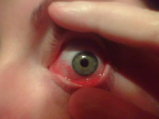 Allergic "pink eye." Allergic conjunctivitis is typically a red, itchy, sometimes burning eye.