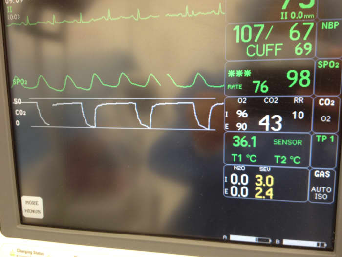 In this photo, the number 98 represents the percentage of oxygen saturation. The white, boxy line represents the breathing pattern. A lot of information is provided to the anesthesiologist by the pattern of this line.