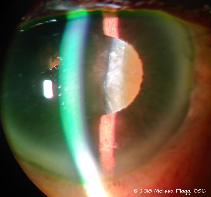 An image of a very mature cataract in an elderly patient. In the center of the pupil you can see the brownish glow we call brunescence, a good sign that this cataract needs to be removed.