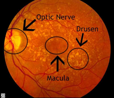 This is what dry AMD looks like.