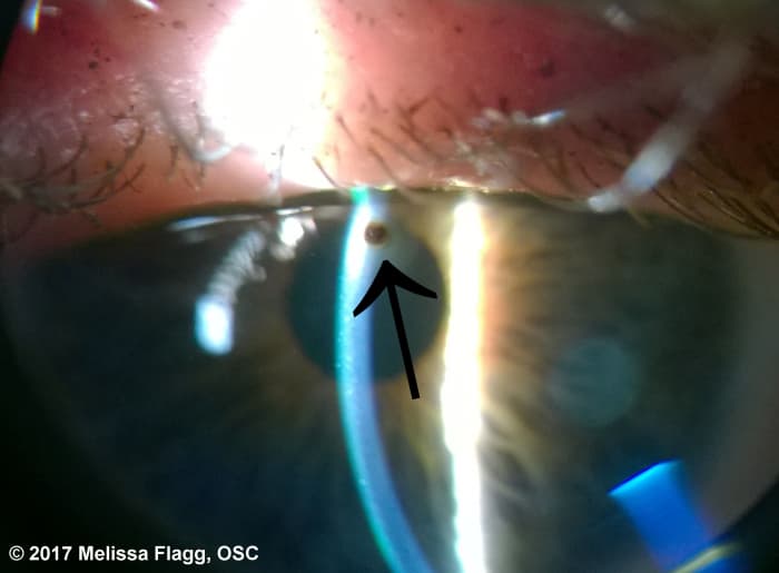 An image of a metallic corneal foreign body in an auto mechanic. Used with permission.