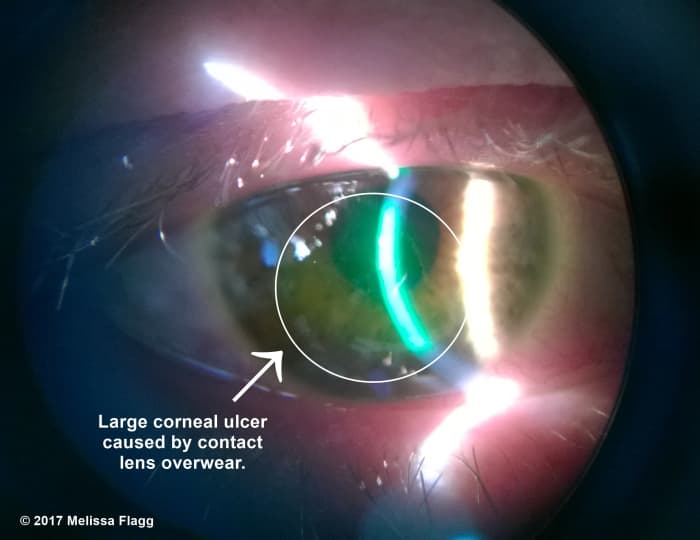 The green colored area in the circle on this patient's cornea is a corneal ulcer caused by contact lens over wear.