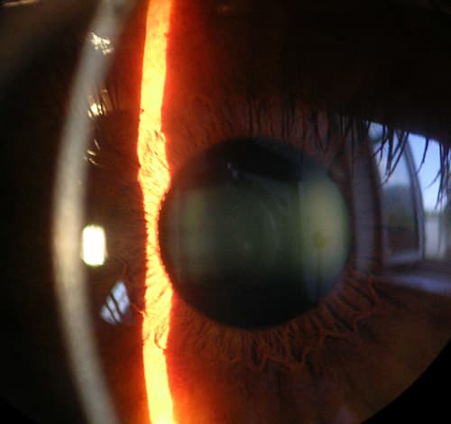 If you look closely, you can see the reflection on the cornea of the window behind the person taking the photo. This is a clear, healthy cornea.
