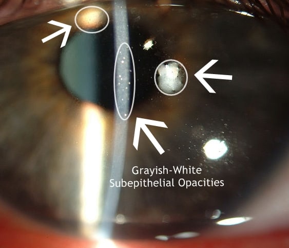 Opacities found on the epithelium