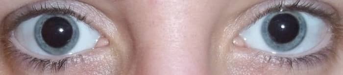 Notice there is more visible iris in this dilated patient than in the photo of the patient dilated with a cycloplegic agent (above).