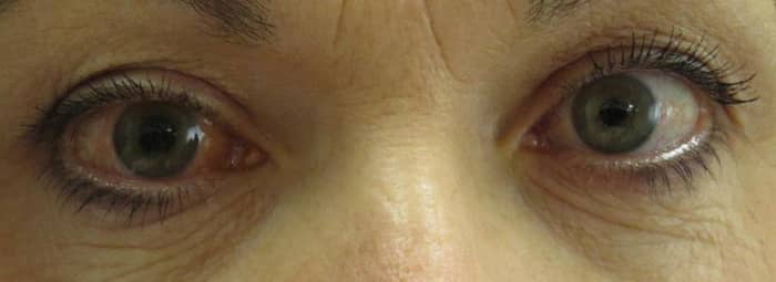 Narrow angle glaucoma in the right eye. Look closely, the right pupil is slightly larger than the left which is typical of an angle closure attack.