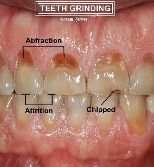 How To Stop Grinding Your Teeth Healthproadvice