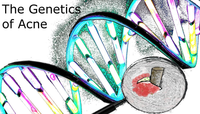 Despite common myths pointing to hygiene or diet as the culprit behind chronic acne, genetic inheritance is the primary cause of this condition.