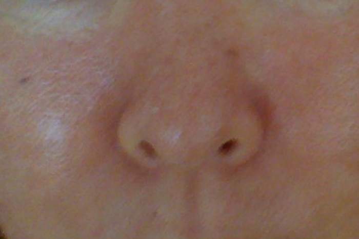 Red face, about 72 hours post Cosmelan 1 application