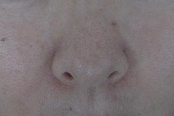 The redness is gone, and friends say my skin looks "so smooooth!"