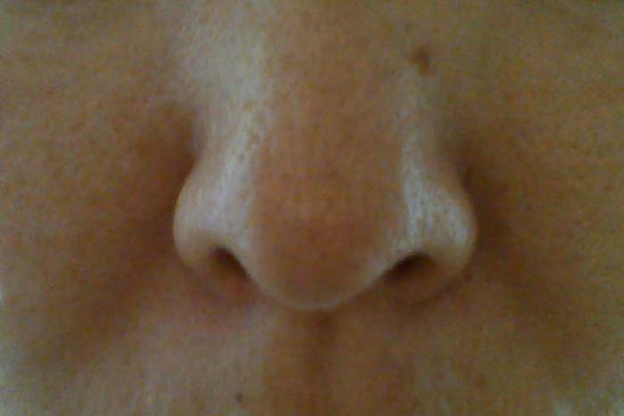 My blotchy, pigmented face before Cosmelan.