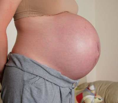 Pregnant bellies may develop stretch marks.