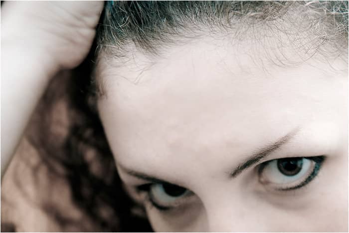 With the Mirena IUD, your hairline may recede or you may notice diffuse shedding all over your head.