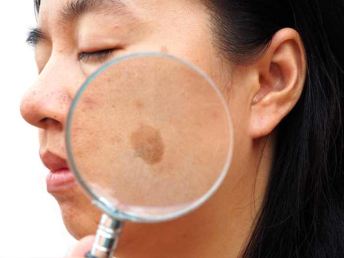 Melasma on Face of Young Woman