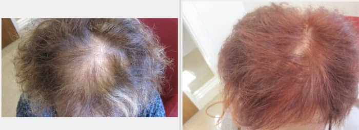Dyeing your hair can help you hide hair loss.