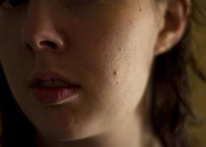 What's the Best Pimple Cream? 2 Effective Ingredients That Zap Zits