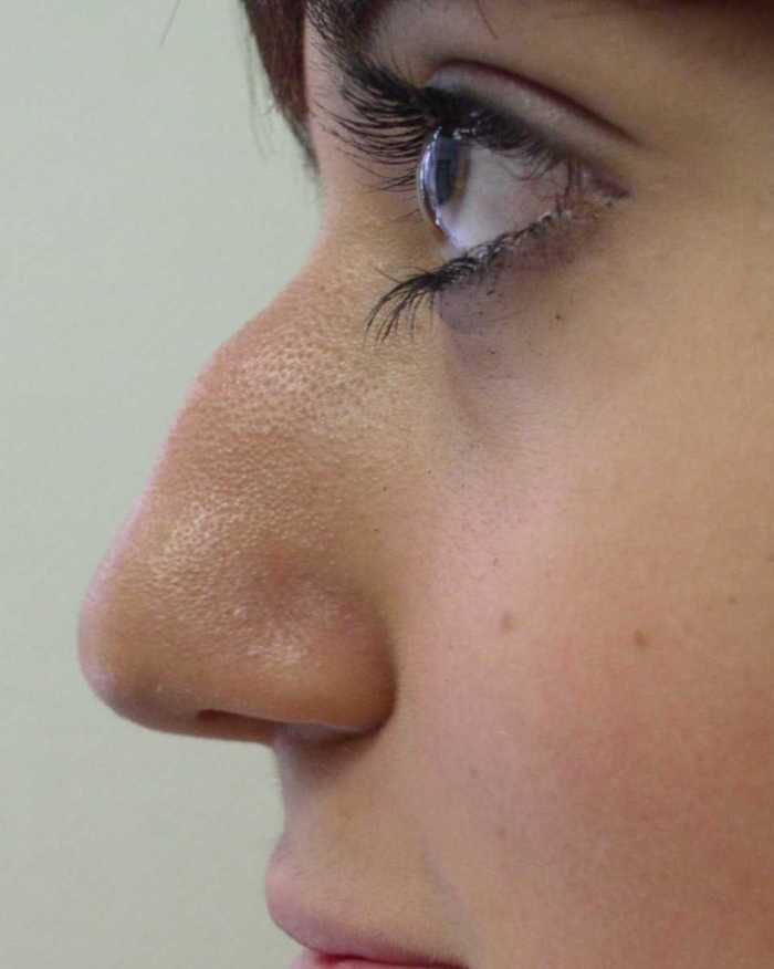 Is Rhinoplasty Worth It? My Nose Job Experience - Bellatory