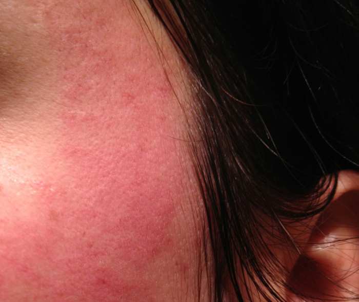 Side Effects of Bentonite and ACV. The redness is normal.