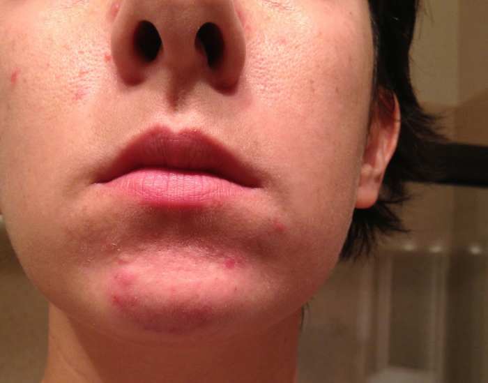Acne on the chin is often caused by hormonal fluctuations.