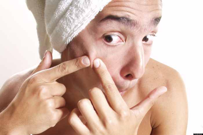 Popping pimples can lead to acne scars.