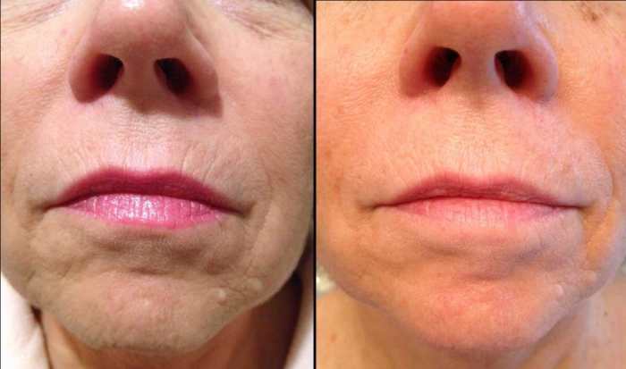 Reduced fine lines and wrinkles