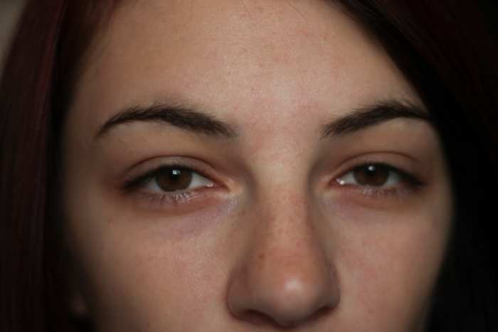 Even after an exceptional night's sleep, I still get pretty bad bags.