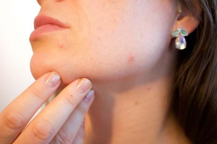 Sufferers of oily skin are prone to spots and acne.