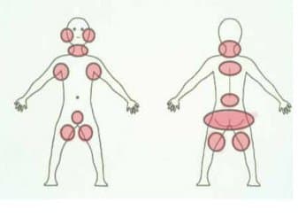 These bruising areas are less likely to be from the normal activities of a child. These areas are more often associated with signs of abuse. A bruise in one area is not generally indicative of abuse, but bruises in several areas, or the same area is