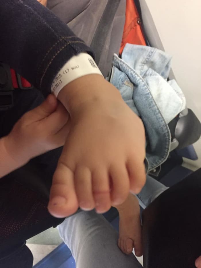 My daughter's toe 24 hours after the tourniquet was removed. The indentation remained for almost a month.