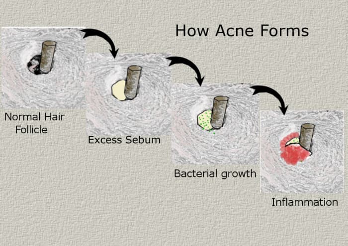 Acne is formed as excess sebum is produced and trapped. Bacteria multiplies in the oxygen-deprived environment and inflammation occurs as the immune system is triggered to respond to the infection.