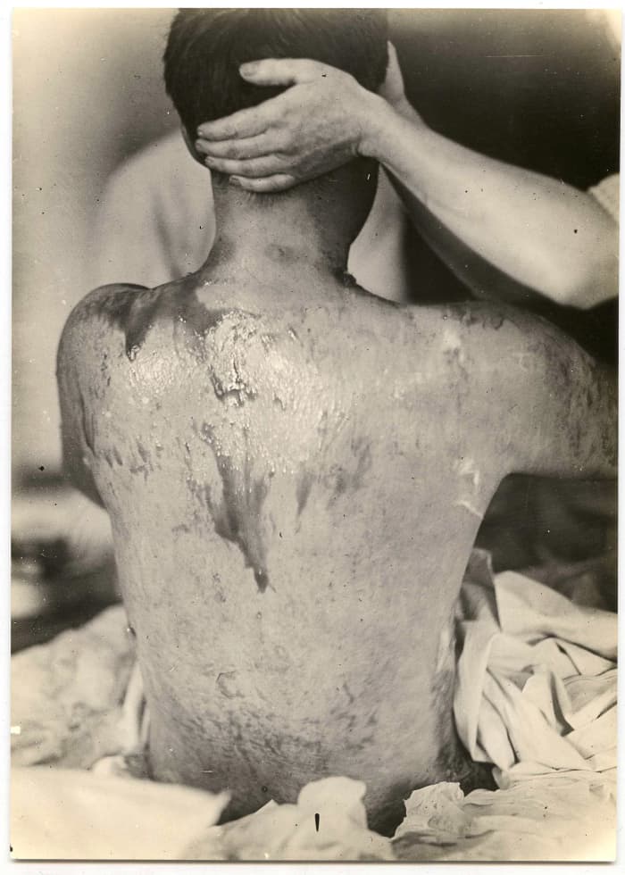 A soldier being treated for mustard gas burns during World War I