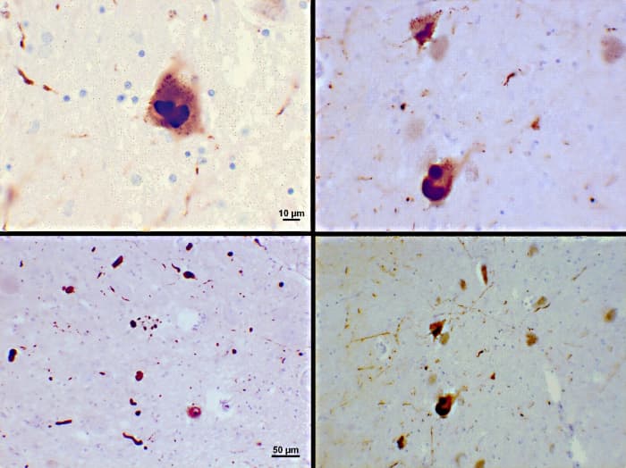 Stained slides showing Lewy bodies (the dark brown patches) in the brain of a Parkinson's disease patient
